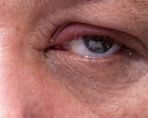 close   infected eye stock image image  stye skin