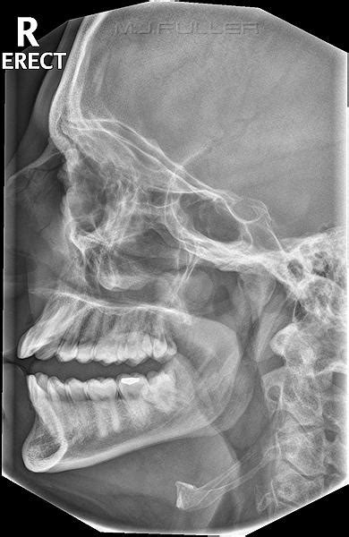 facial bones x ray milf bondage sex