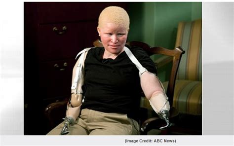 ciencia and raza scientific race tanzania s albinos are