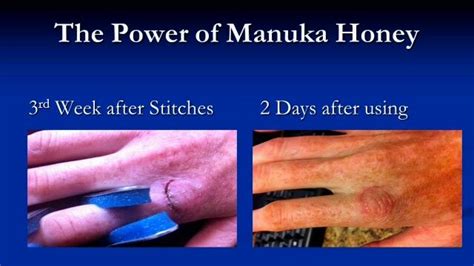 Manuka Honey For Wound Care Nursing Skin And Wound Care