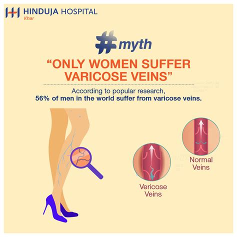 Only Women Suffer Varicose Veins Genetics Play A Major Rol Flickr