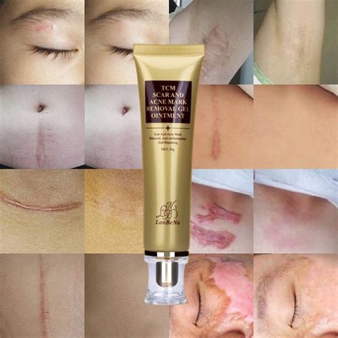 Scar Remover Serum Acne Scars And Stretch Marks Hot Deal