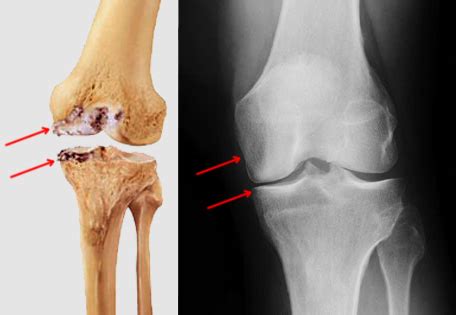 partial knee replacement       steph pratt