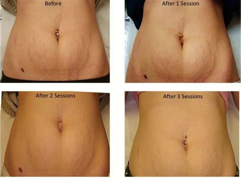 Laser Stretch Mark Removal Doctors Review Before And After