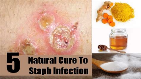5 home remedies for staph infection on face youtube