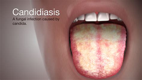 Candidiasis Shown And Explained Using A Medical Animation Still Shot