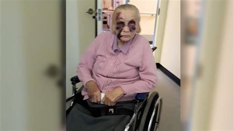 elderly woman left bruised cut after falling from her wheelchair at