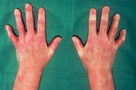 systemic sclerosis  symptoms treatment systemic sclerosis