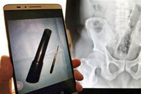 man with heavy duty torch stuck up his bottom refuses to tell doctors