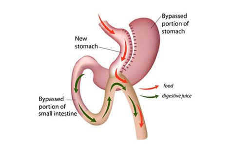 Mini Gastric Bypass Slimming Center In Pune