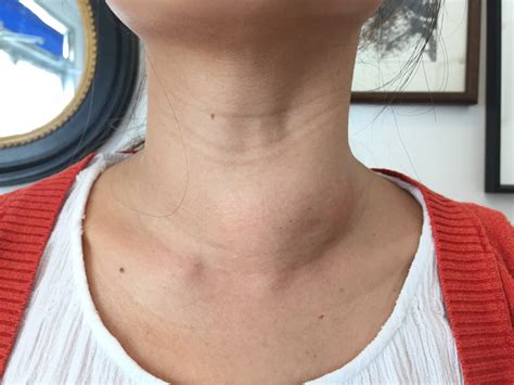 thyroid goiters  nodules  thyroid center  santa monica