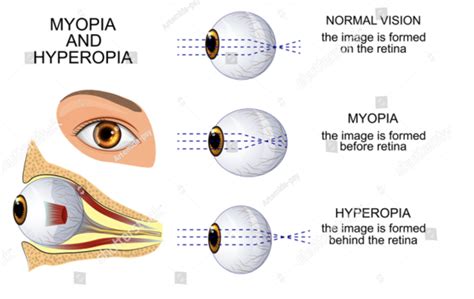astigmatism and myopia difference astigmatism glaucoma