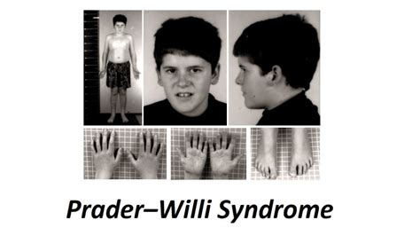 Prader–willi Syndrome Definition 13 Symptoms Causes And Treatment