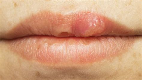 hpv and lip sores hpv mouth sores