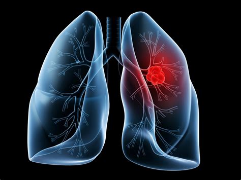 research identifies genetic alterations  lung cancers