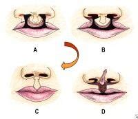 bilateral cleft lip repair background history   procedure problem