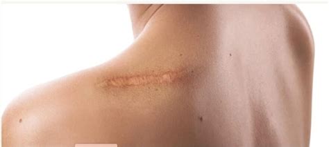 diminish post surgical scars sanara medtech