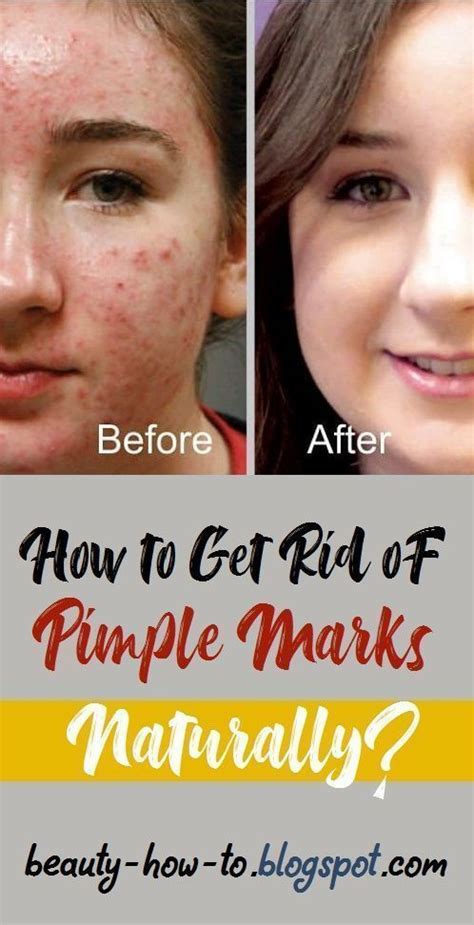 how to get rid of pimple marks naturally marks naturally pimple