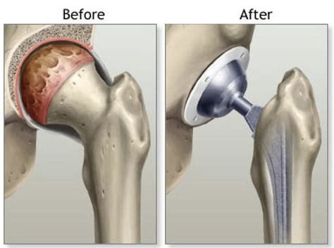 Anterior Approach Total Hip Replacement Aa Thr – St George Surgical