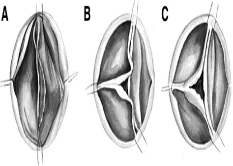 The Sievers Classification Of The Bicuspid Aortic Valve For The
