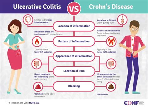 ulcerative colitis  crohns disease whats  difference