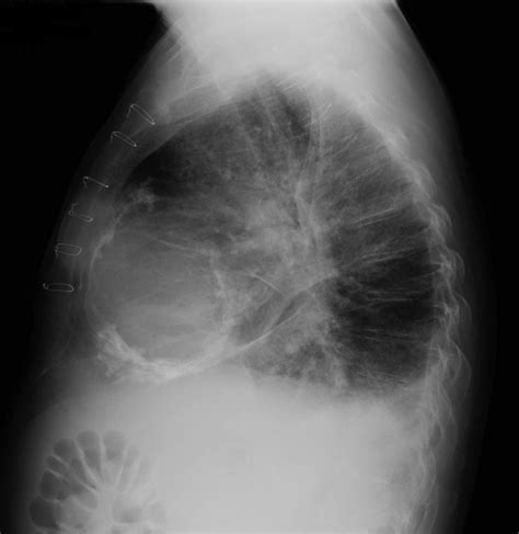 Chest X Ray Left Lateral View Showing Calcification Of The Cardiac