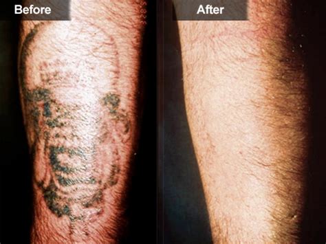 tattoo removal mclean woodbridge virginia skin laser surgery center