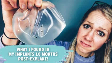 breast implant illness can you get mold in your breast implants youtube