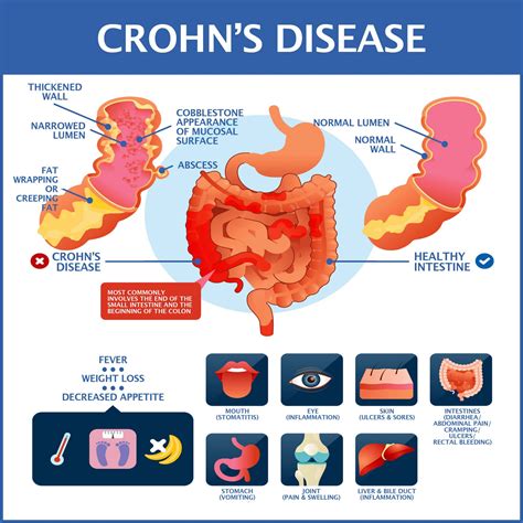 diagnosed  crohns disease gastroenterology  greater orlando