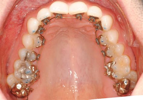 How Much Do Incognito Braces Cost Masri Orthodontics