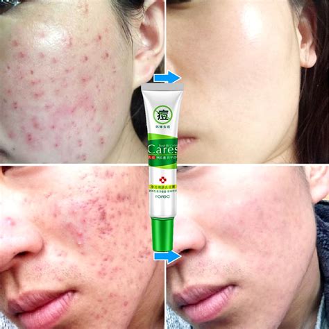rorec acne treatment moisturizing skin care acne remover face cream