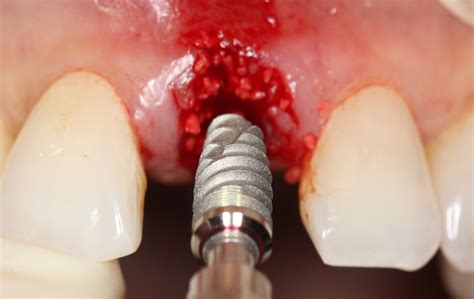 surgical placement  dental implants  restorative driven approach