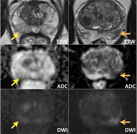 The Radiology Assistant Prostate Cancer Pi Rads V2