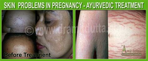 problems in pregnancy dr amit dutta best ayurvedic doctor and skin