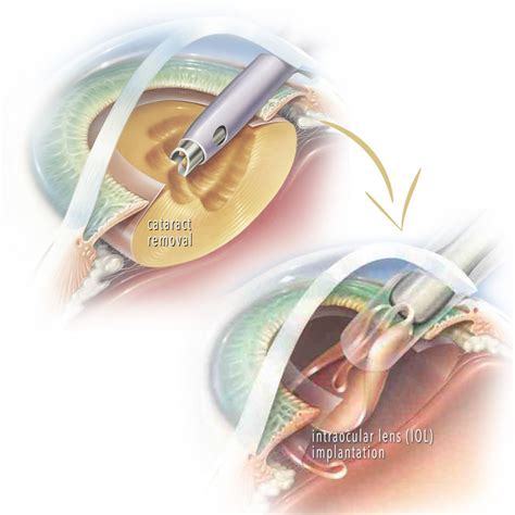 premium cataract surgery and smart intraocular lenses