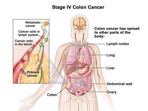 Colon Cancer Stage 4
