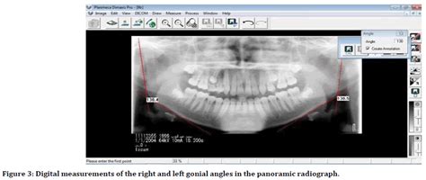 medical dental science left gonial angles