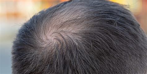 handle  bald spot miami hair institute