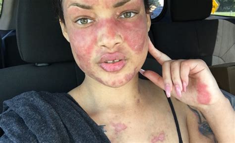 How Women Are Raising Lupus Awareness On Instagram She Explores Life