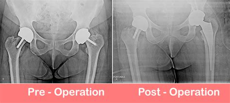 total hip replacement dr shekhar agarwal best joint replacement