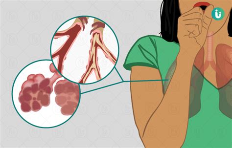 copd chronic obstructive pulmonary disease symptoms
