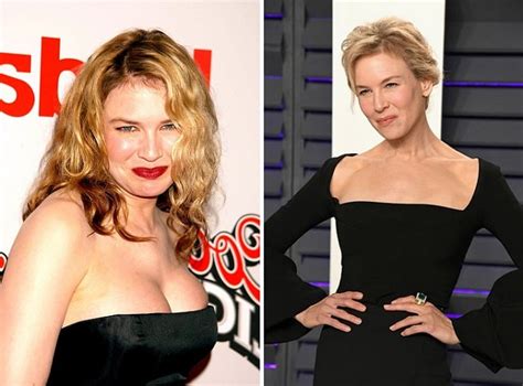 Renee Zellweger Before And After Plastic Surgery Facelift Botox