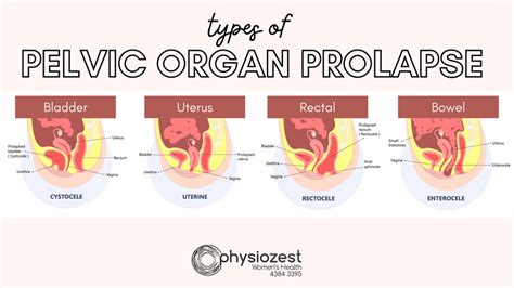 Using A Pessary For Symptoms Of Prolapse