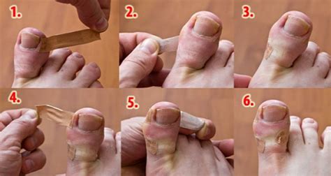 traitement naturel des ongles incarnes simple  efficace