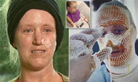 Mother And Daughter 5 Suffer Horrific Burns After Decorative Burner