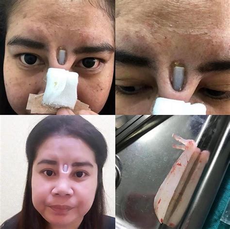 woman s botched nose job leaves her with implant poking