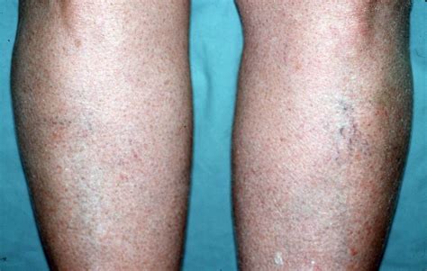 winterjeuk en droge huid benen huidartscom