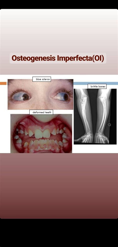 Pin By Dr Mooni On Orthopedics Osteogenesis Imperfecta Brittle Bone