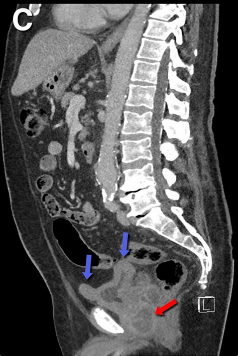 panel c ct scan of abdomen and pelvis in sagittal view showing