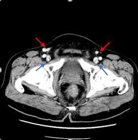 The Ct Image Shows The Presence Of Inguinal Lymph Nodes My Xxx Hot Girl
